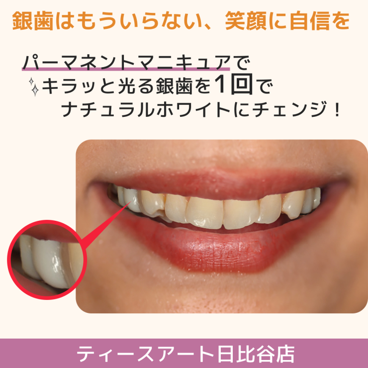 どんな歯でも一回で真っ白な歯に。「パーマネントマニキュア」のご紹介！